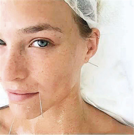 萊昂納多前女友、以色列內(nèi)衣超模芭兒·萊法利（Bar Refaeli）曾在社交平臺(tái)上分享了自己面部針灸時(shí)的樣子，照片中芭兒素顏正躺，臉上多個(gè)穴位規(guī)則布針。(美國(guó)《僑報(bào)》摘自網(wǎng)絡(luò)圖片)