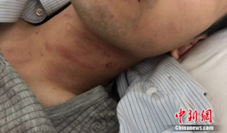 受傷的謝某。 鐘欣 攝