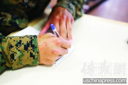 劉中杰手上已經滿是傷痕。（美國《僑報》/陳沉 攝）