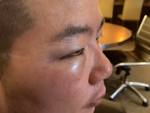 華裔家庭日前在法拉盛遭非洲裔侮辱、攻擊、性騷擾、砸車，華裔父親臉部被揍多拳，右眼瘀青腫漲嚴(yán)重。(來源：美國《世界日報》記者賴蕙榆 攝 )
